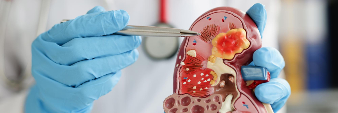 RIRS - Retrograde Intra Renal Surgery The "No-Cut" Revolution In Urology