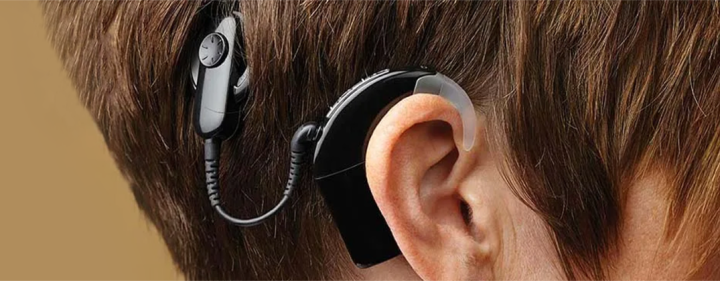 Understanding Cochlear Implants: A New Era in Hearing Solutions