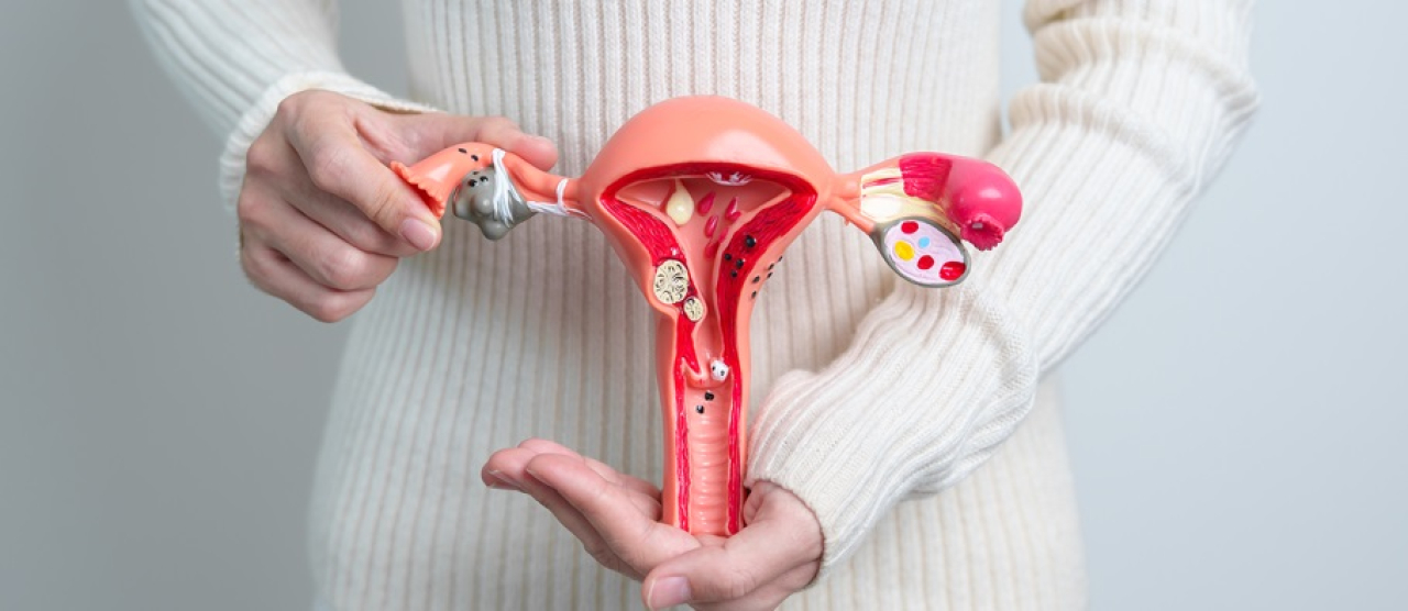 Understanding PCOS and Its Impact on Fertility