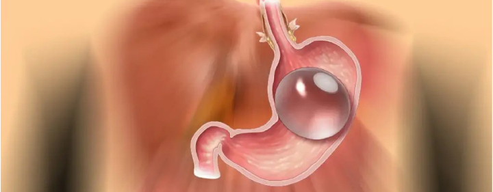 Intragastric Balloon