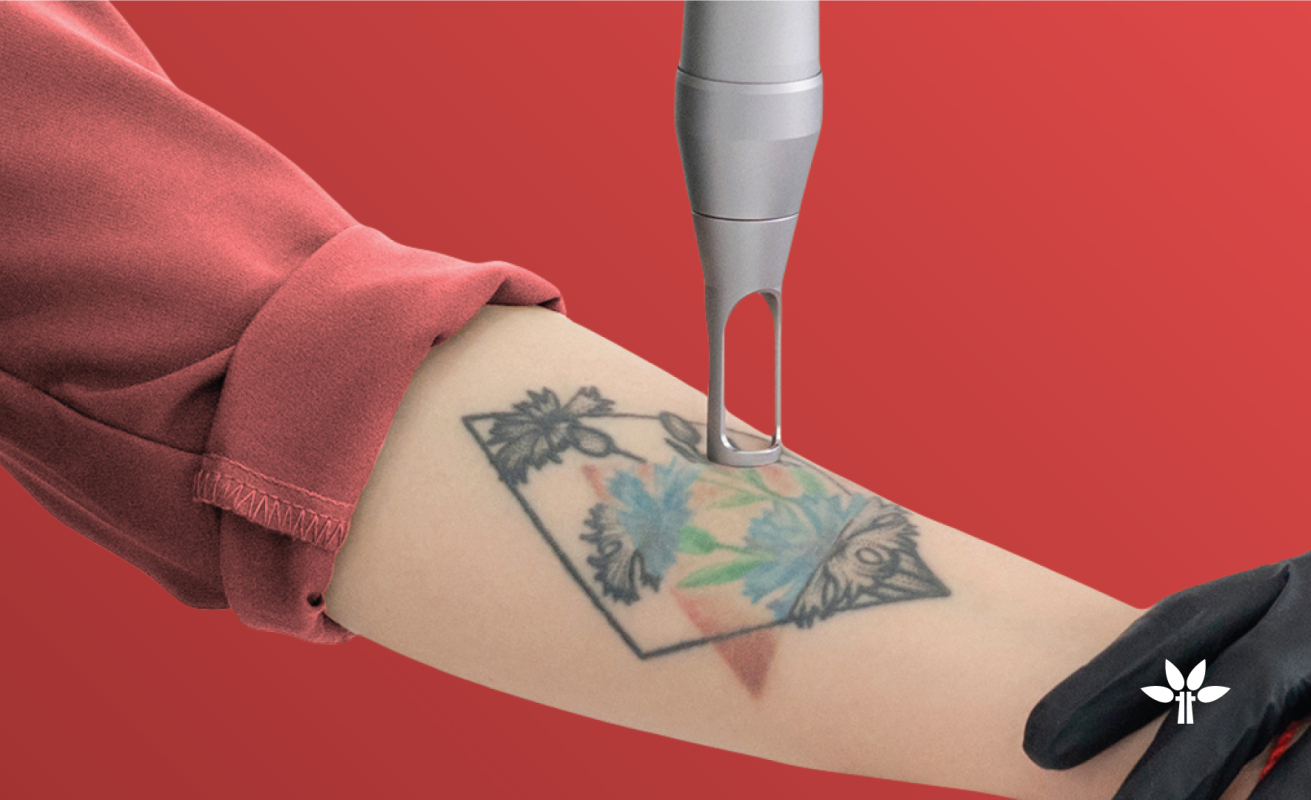 Tattoo Removal Treatments